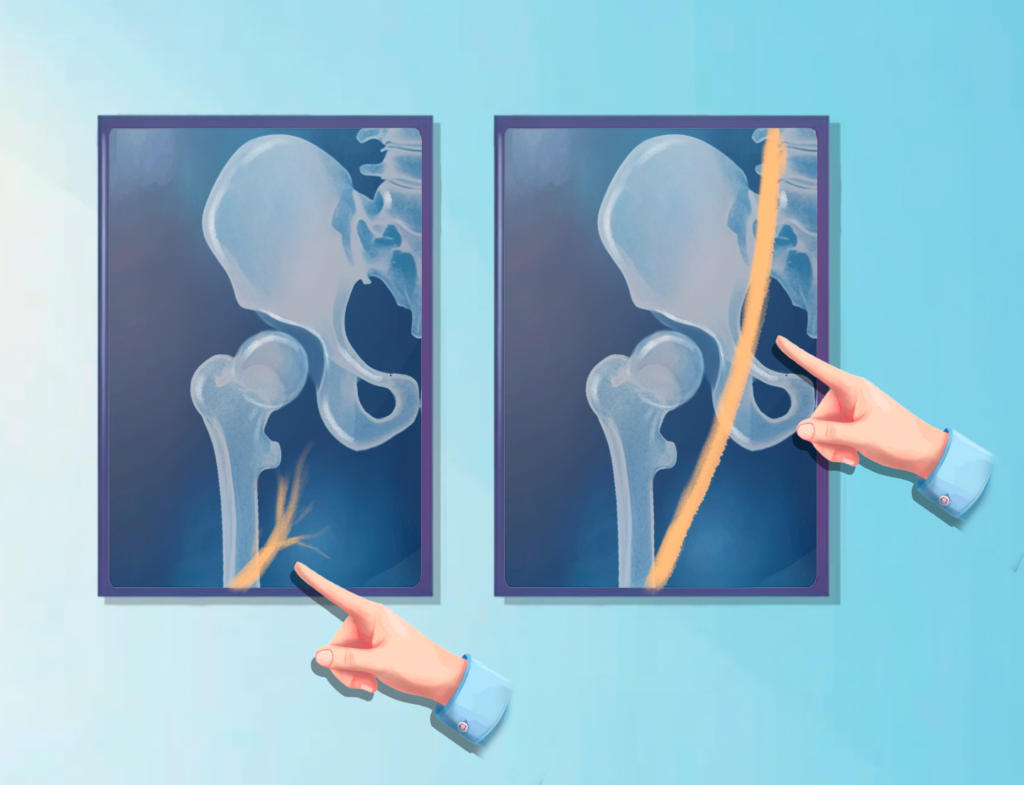 Iliac vein obstruction before and after stenting