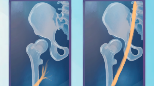 Iliac Vein Obstruction Pre and Post