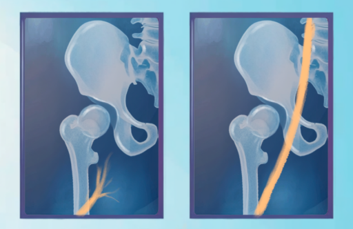 Iliac Vein Obstruction Pre and Post