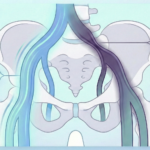 Illustration showing iliac vein compression