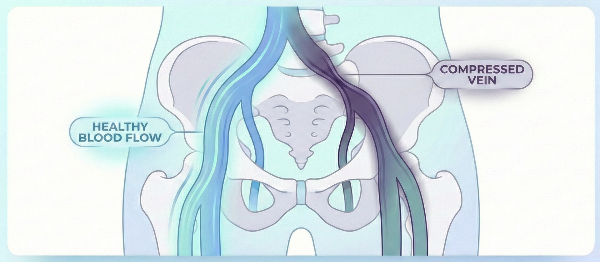 Illustration showing iliac vein compression