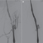 Veins post VenaCore catheter
