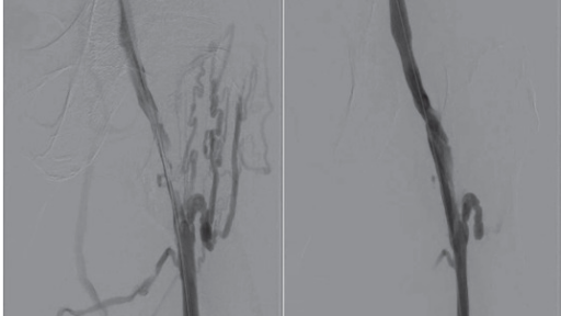 Veins post VenaCore catheter