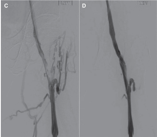 Veins post VenaCore catheter