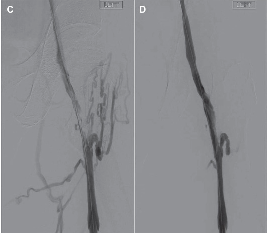Veins post VenaCore catheter